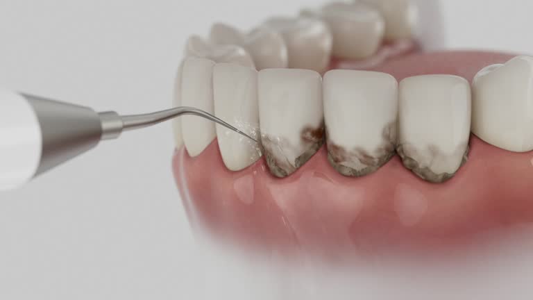 Trusted Tooth Extraction service in Seven Hills, OH - Dentist Open Now